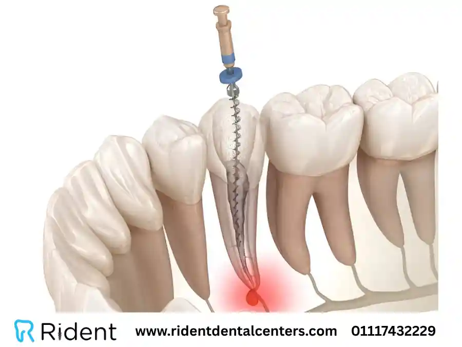 هل حشو العصب مؤلم؟